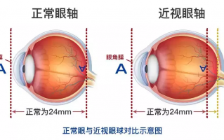 屈光轴位正常是多少，屈光轴位a多少正常